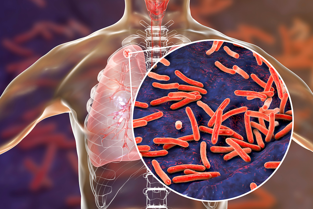 Featured image for “What Nigeria must do to prevent more deaths from tuberculosis”