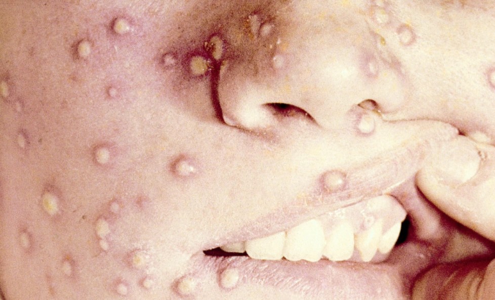 Featured image for “Monkeypox case reported in Brazil”