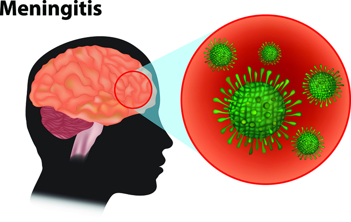Featured image for “Meningitis Outbreak Kills 65 Persons In Jigawa, Nigeria”